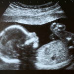 Toxicité fœtale et néonatale des inhibiteurs de l’enzyme de conversion et des sartans - quelle surveillance pour les enfants exposés in utero ?